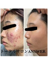 アンサー(ANSWER)/肌育ケアもお任せ下さい！