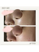 サロン ド ミコラ(salon de Micora)/次世代美容液毛穴洗浄