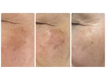 ルビー(RUBY)/プラズマでしみ改善