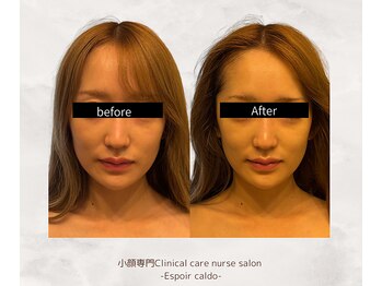 エスポワールカルド(Espoir caldo)/贅沢小顔フルコース