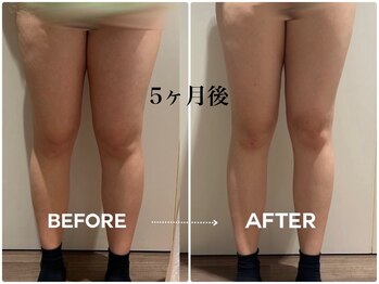 シフト 原宿店(SHIFT)/脂肪冷却 太もも 5回目