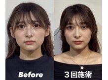 コルミチョン サロン(骨美整 salon)/Before・After(エラ張り)