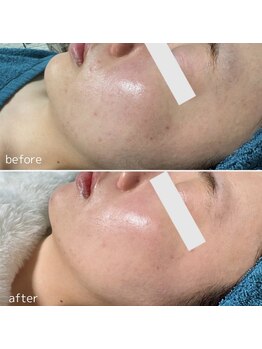 アンドワイ バイ サロンリーナ(&y by Salon Lena)の写真/剥けないハーブピーリング♪剥離なしで、直後からお化粧OK◎様々な肌の悩みに万能!《ご新規様限定¥7500》