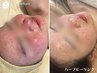 【肌トラブルと絶縁する】剥けないハーブピーリング 敏感肌,赤ら顔さんにも◎