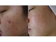 京都美顔/１０代・学生さんのニキビケア