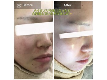 モカ 天王寺店(MOKA)/顎ニキビ　ハーブピーリング 跡