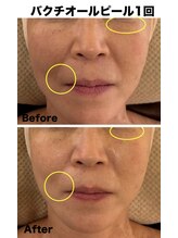 マスカレード(Masquerade)/バクチオールピール症例写真