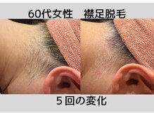 ビモア(Bmore)/★ビフォーアフター★