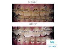 ホワイトニングショップ 奈良生駒店/矯正中もホワイトニングできます