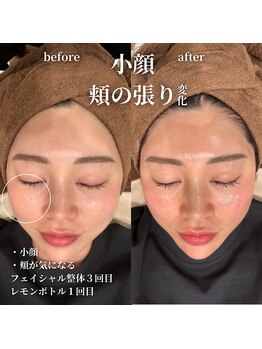 フェアリーフェイス 南森町店(Fairy Face)/南森町/小顔矯正&レモンボトル