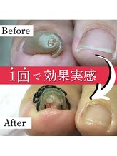 巻き爪矯正センター 沖縄 宜野湾/