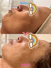 はだなの/ビフォーアフター　炭酸パック