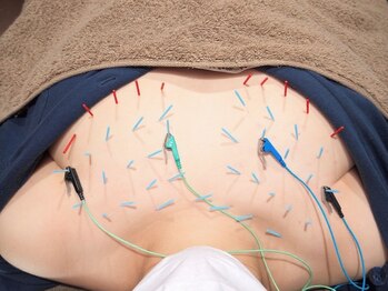 鍼灸院 満月の写真/【頭皮ケア・バストケア・腰痛・肩こり・姿勢改善】根本改善で姿勢も美しく!美容メニューも充実の本格鍼灸!