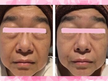 アイリープ(eyeleap)/深刻目元悩み/目元美人premium