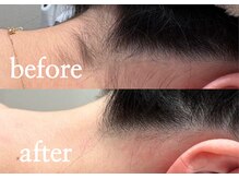 ボヌール(bonheur)/うなじ脱毛