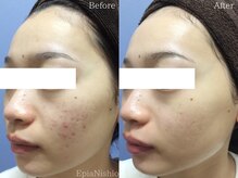 エピア 西尾店(Epia)/頬ニキビ/20代女性