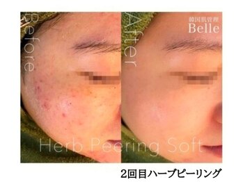 ベル 草津(Belle)/毛穴洗浄｜ニキビケア