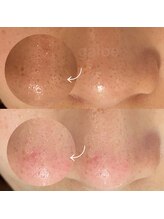 ミニョンプラス(Mignon+)/毛穴エクストラクションプロ