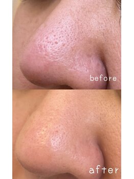 リリールア(Rere-Rua)/毛穴改善！