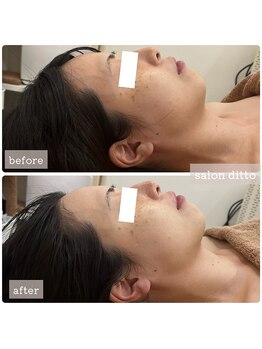 サロンディト(ditto)/【施術5回】小顔コルギ+肩甲骨