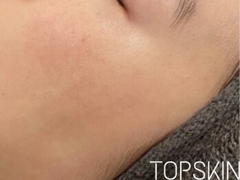 トップスキン 名駅(TOPSKIN)/正常な肌周期へと肌質が変化!