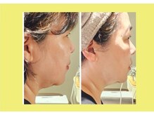 アン 銀座(ann)/レモンボトル1回目