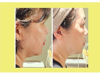 アン 銀座(ann)/レモンボトル1回目