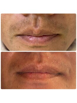 シューティングハーツ(SHOOTING HEARTS)/ヒゲ脱毛