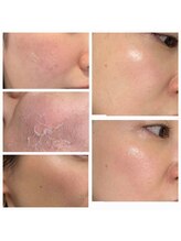 リラ 都城店(Lilas)/ハーブピーリング剥離