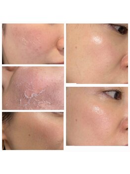 リラ 都城店(Lilas)/ハーブピーリング剥離