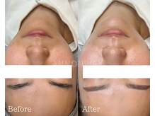 ポアラ(POARA)/毛穴/ワックス脱毛