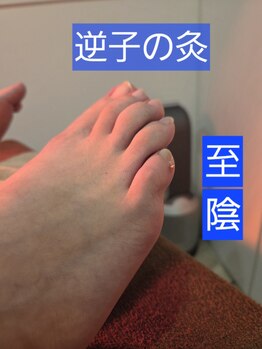 ムラサキ鍼灸治療院(MURASAKI鍼灸治療院)/逆子にお灸