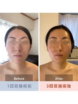 パピヨン(papillon)/ビフォーアフター