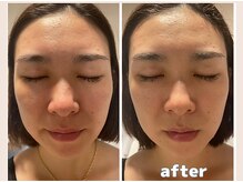 エヴァル 久留米店(ewalu)/温熱小顔リフト