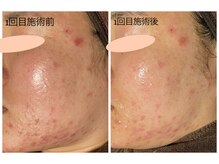 おうちサロン ミキ/漢方ハーブピーリング1回