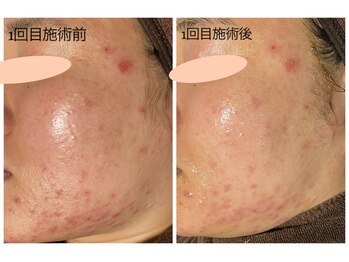 おうちサロン ミキ/漢方ハーブピーリング1回