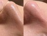 頑固ないちご鼻スペシャルケア★（毛穴洗浄→脱毛orサーマルFR→美容液導入）