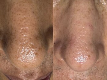 サラグランデ(Sara Grande)/男性にも大人気毛穴コース