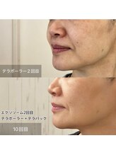 リアプア(Li'a)/毛穴とくすみ改善叶えませんか？