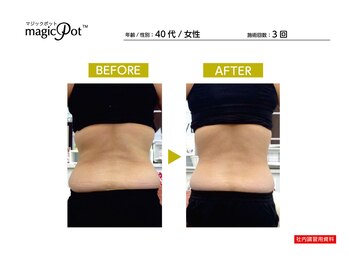 ラトナ(RATNA)の写真/ラジオ波で夏までにサイズダウン！落ちづらいお腹周り・二の腕を集中ケア！内蔵脂肪にもアプローチ★