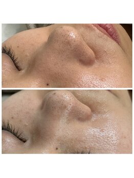 アレーズ(a l'aise)/黒ずみ毛穴もこの通り！！！