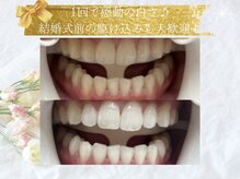 ココティ ホワイトニング(Cocotii)の雰囲気（最新技術【超音波×LEDホワイトニング】1回でのビフォーアフター）