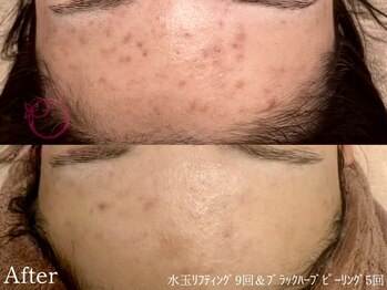 サロンヴェアリー 広尾(salon vary)/古いあとには絶対ブラック！