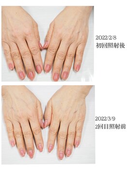 ネイル キャンバス シルヴァ(Nail Canvas Silva.)/美肌光エステの効果!