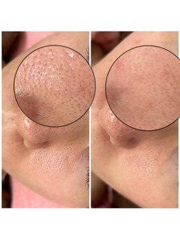 クラティス(CRATIS)/【レチノール】肌質改善艶肌へ