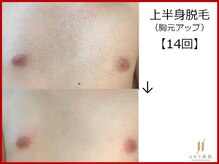 ひかり素肌/上半身脱毛14回