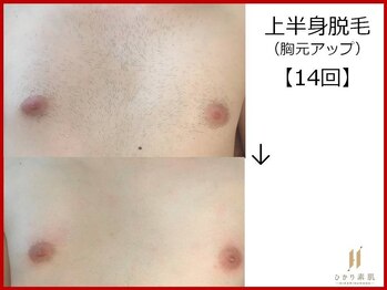 ひかり素肌/上半身脱毛14回