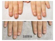 グレースレディ 大阪店/(深爪/長さだし/フィルイン)