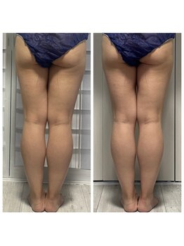 グランドール(Grandeur)/痩身