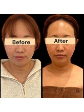 ワイズ 沖縄うるま院(Medical Y's)/糸リフトにも負けなボトサリフト